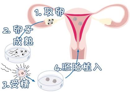 关于国内试管供卵代孕